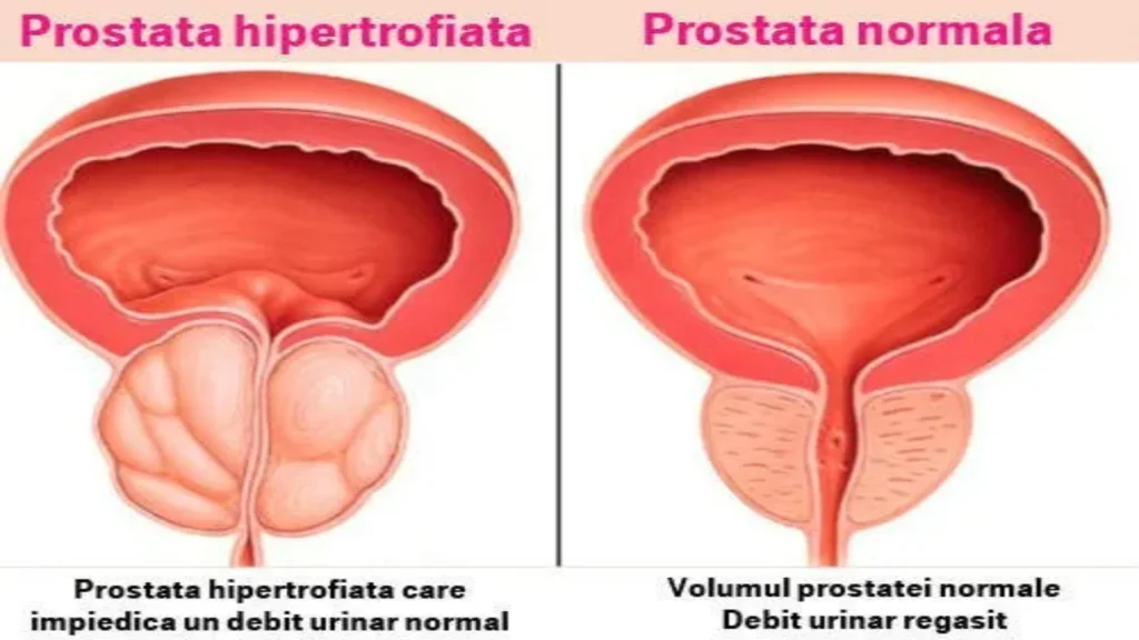 Hardica prostate formula - mga pagsusuri - mga komento - presyo - saan bibili - kung ano ito - opinyon - mga review - Pilipinas